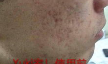 男生器官上长了痘痘是因为什么,从日常护理到专业治疗全方位解析