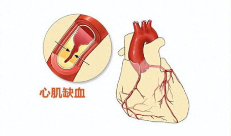 心肌缺血有什么症状和表现,识别早期症状,守护心脏健康